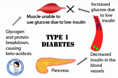type 1 diabetes.gif